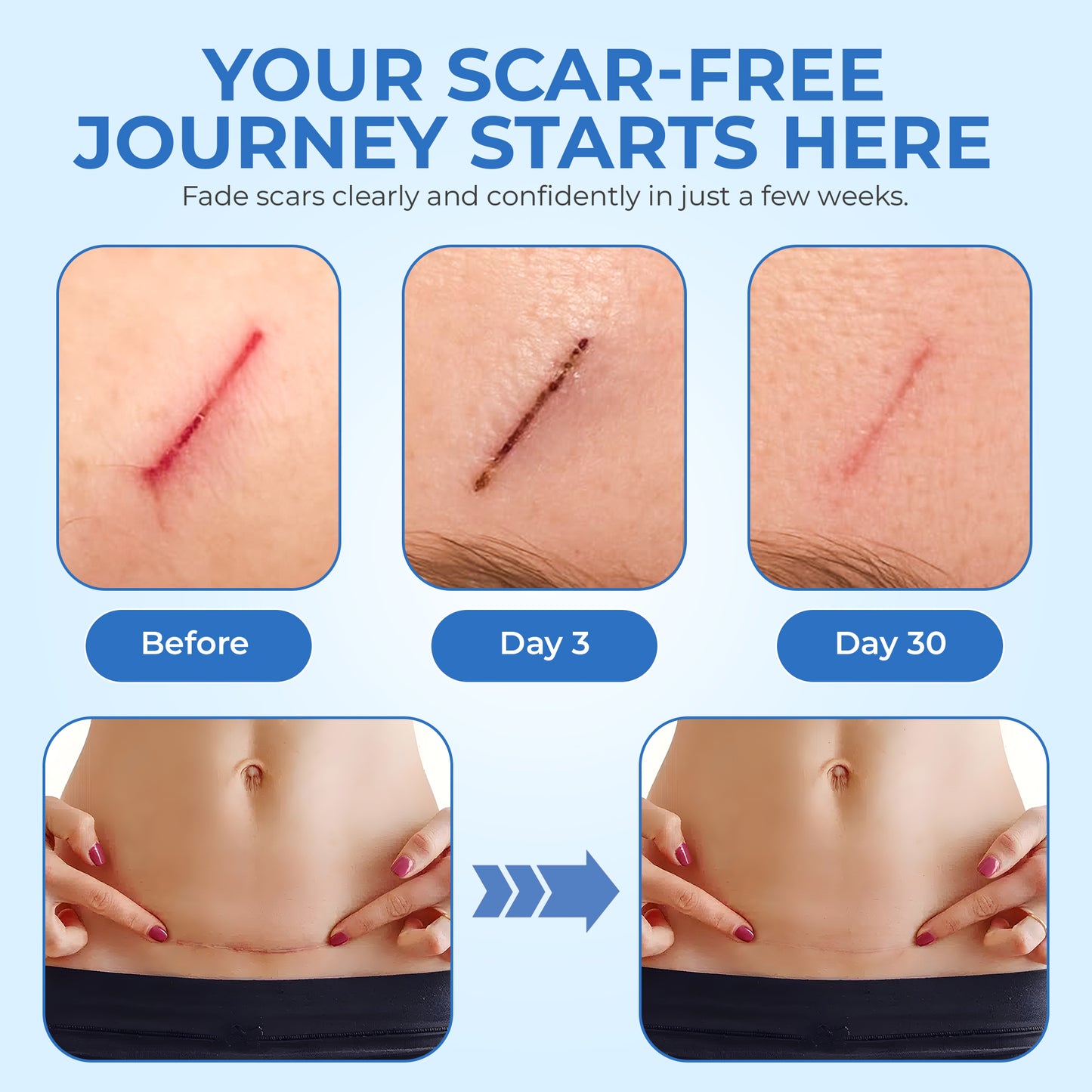 ScarFix+ | Transparent Silicone Scar Plasters for Surgery, Acne & Stretch Marks