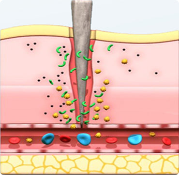 Why Scars Form:
