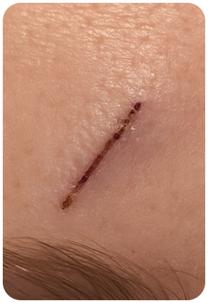 Scar improvement 02