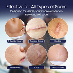 ScarFix+ | Transparent Silicone Scar Plasters for Surgery, Acne & Stretch Marks My Store