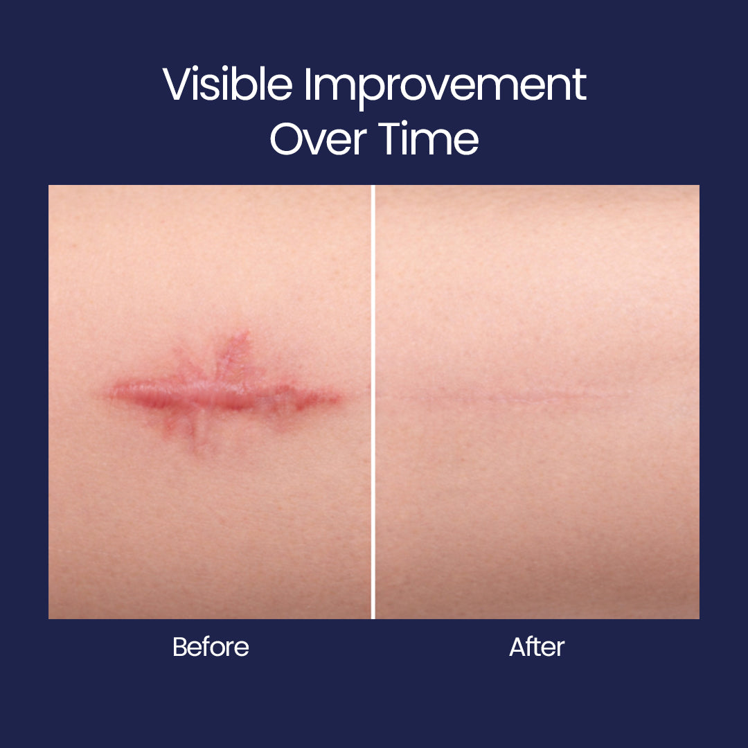 ScarFix+ | Transparent Silicone Scar Plasters for Surgery, Acne & Stretch Marks My Store