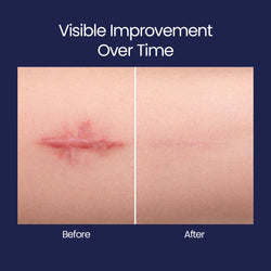 ScarFix+ | Transparent Silicone Scar Plasters for Surgery, Acne & Stretch Marks My Store