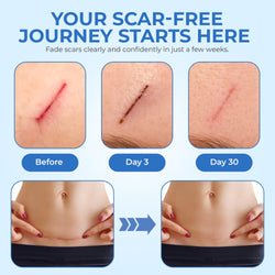 ScarFix+ | Transparent Silicone Scar Plasters for Surgery, Acne & Stretch Marks