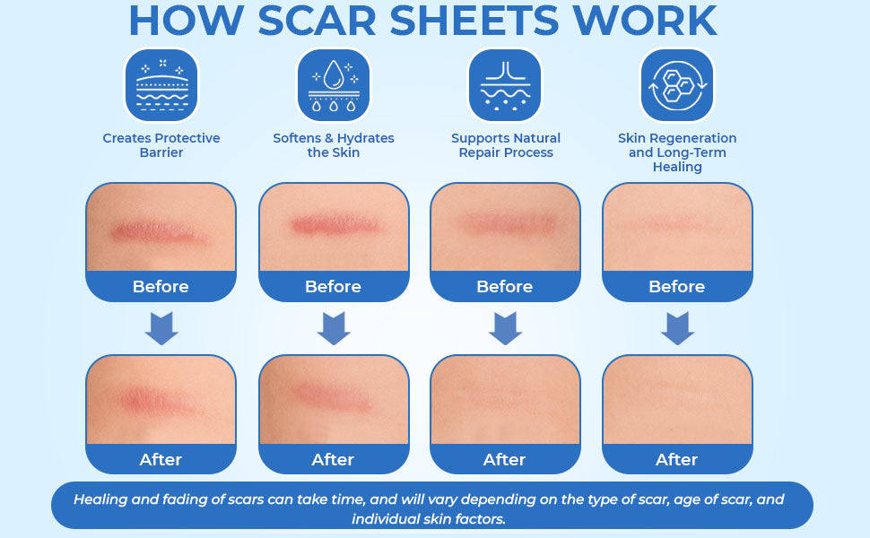 ScarFix+ | Transparent Silicone Scar Plasters for Surgery, Acne & Stretch Marks