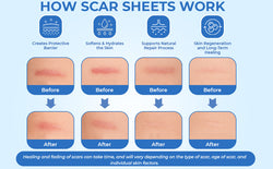 ScarFix+ | Transparent Silicone Scar Plasters for Surgery, Acne & Stretch Marks