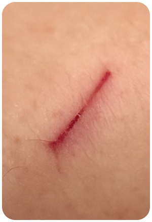 Scar improvement 01