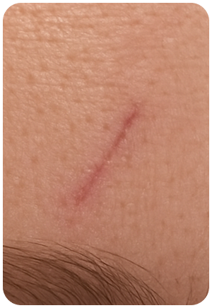Scar improvement 03